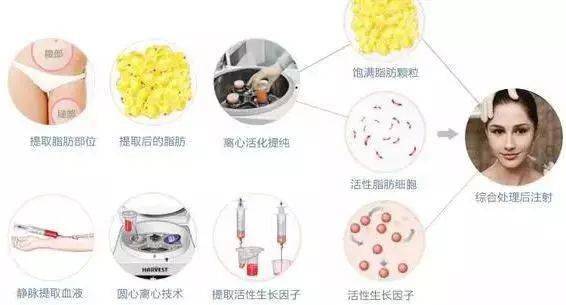 皮下脂肪细胞,然后吸出的混合物经净化处理,注入药物得到复合脂肪颗粒
