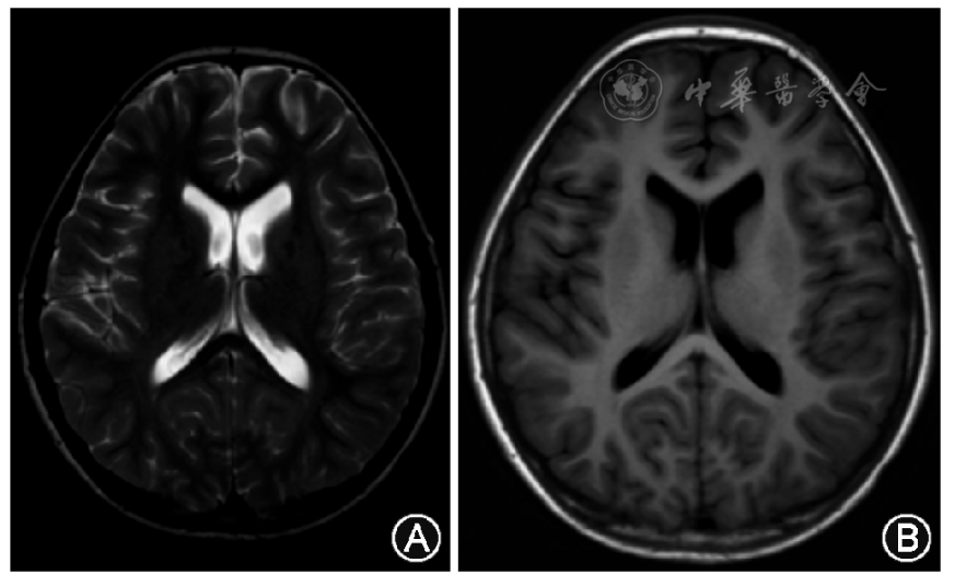 例1为男性患儿,病程2个月时头颅磁共振成像t   wi(a)及t   wi(b)示