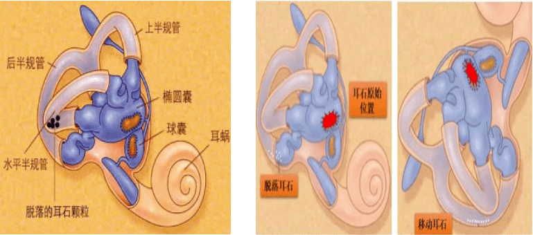 【特色技术】南安市医院:耳石迷途如何办 手法复位助知返