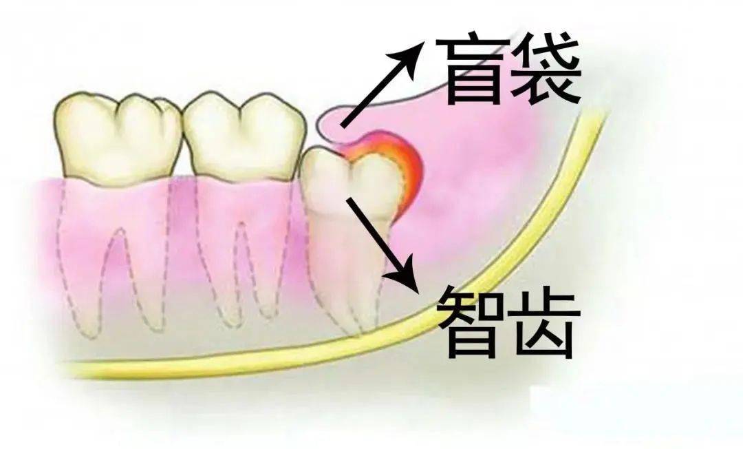 2 智齿冠周炎 盲袋是食物残渣和细菌集聚的重灾区,一般很难通过漱口