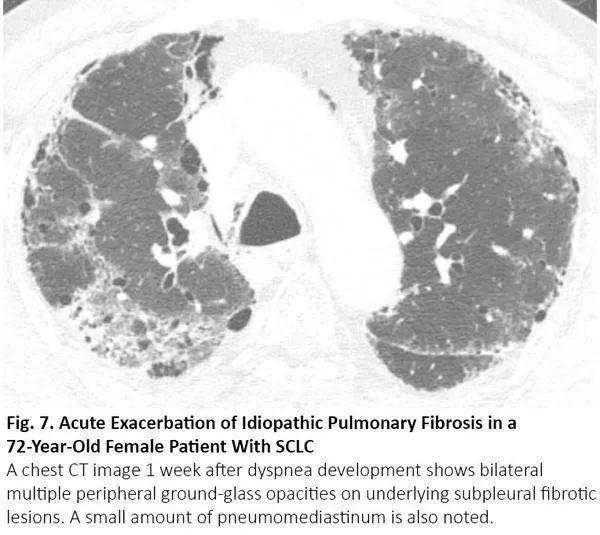 当患者接受手术或放疗时,若特发性肺纤维化急性加重,ct可呈现双肺弥漫