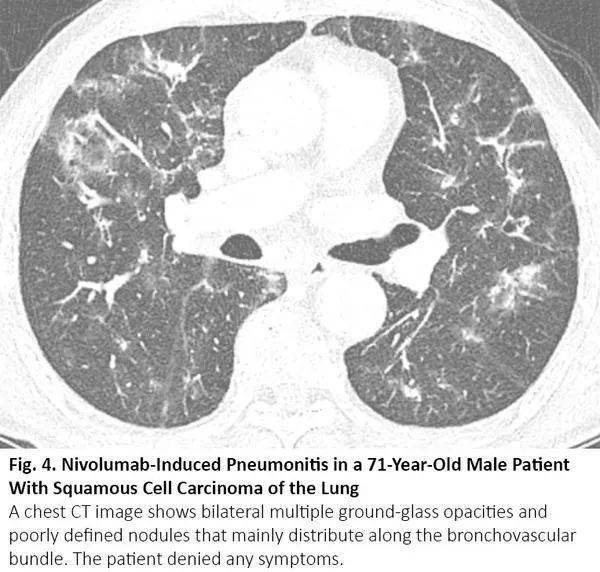 一位71岁肺鳞癌男性患者出现纳武利尤单抗治疗导致的肺炎