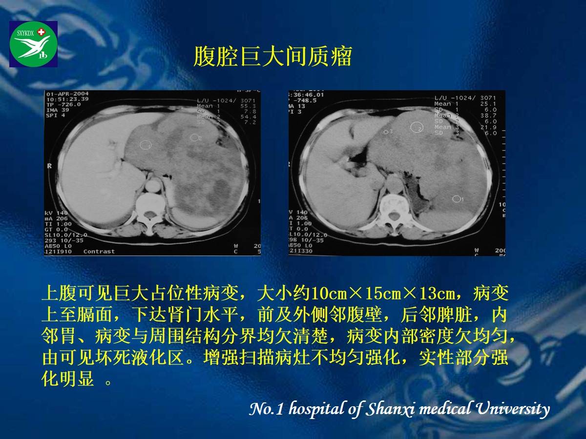 李健丁教授胃肠道外间质瘤的ct表现和临床病理分析