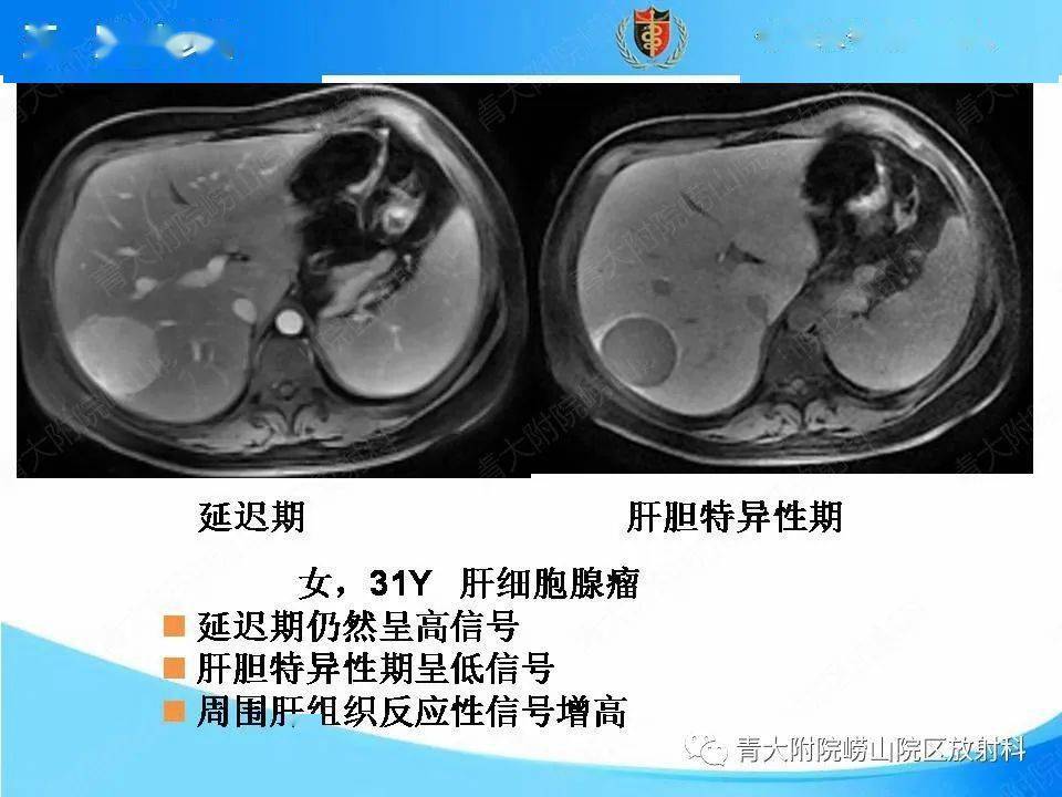 肝脏局灶性结节增生的ct及mri诊断及鉴别诊断要点