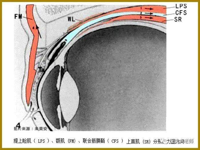 结膜上穹窿联合筋膜鞘(cfs)悬吊术