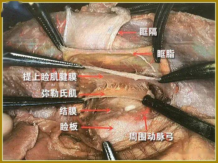 结膜上穹窿联合筋膜鞘cfs悬吊术