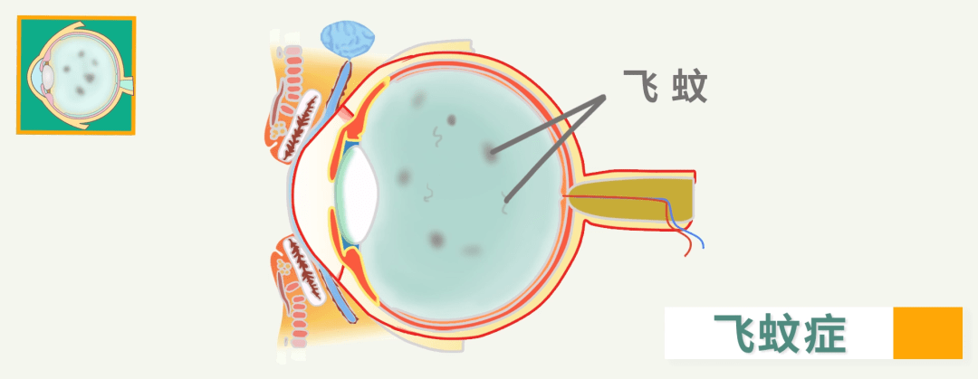 一文读懂 | 一种有意思的眼疾——"飞蚊症"_玻璃体