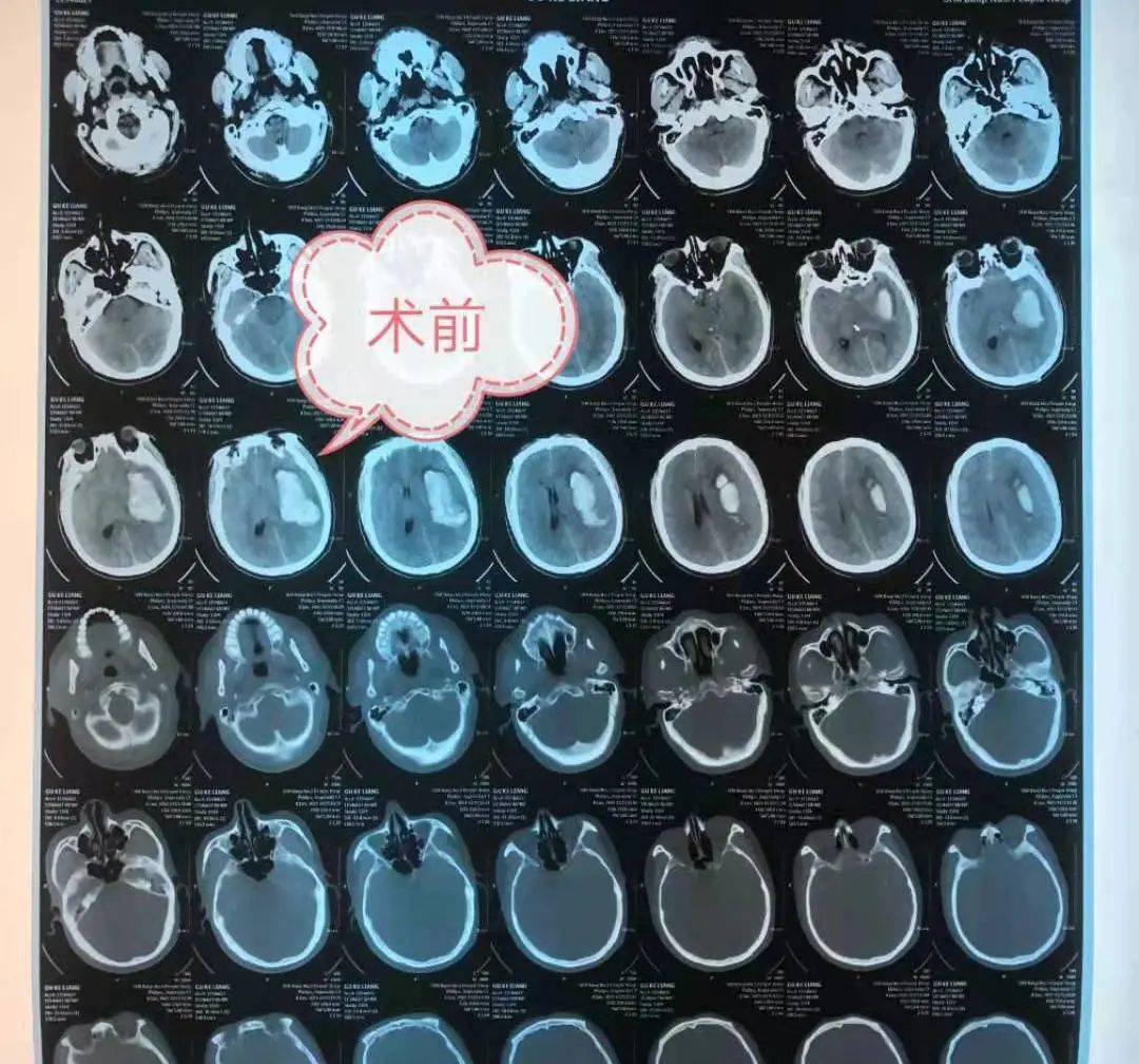 大小便失禁,家人呼120送入我院,急诊查头颅ct提示:左侧基底节区脑出血