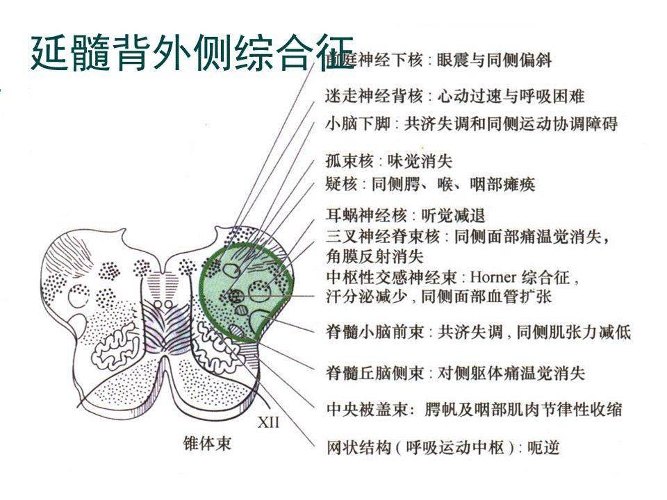 延髓背外侧综合征wallenberg综合征