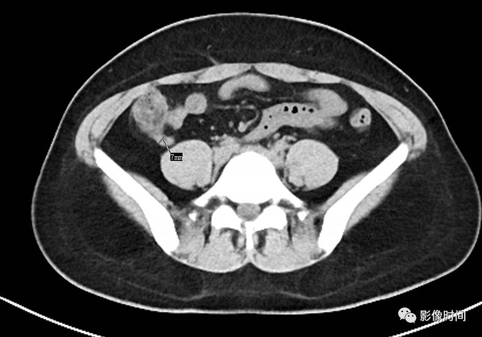 外科医生必需掌握的阑尾炎 ct 表现