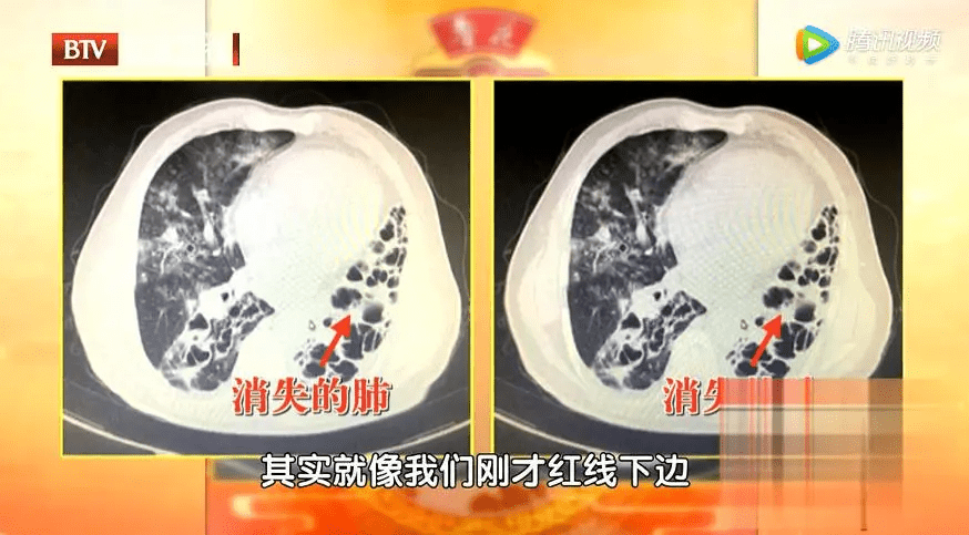 而在支气管扩张部位潴留的痰液很容易引起细菌繁殖,这些细菌在肺部安