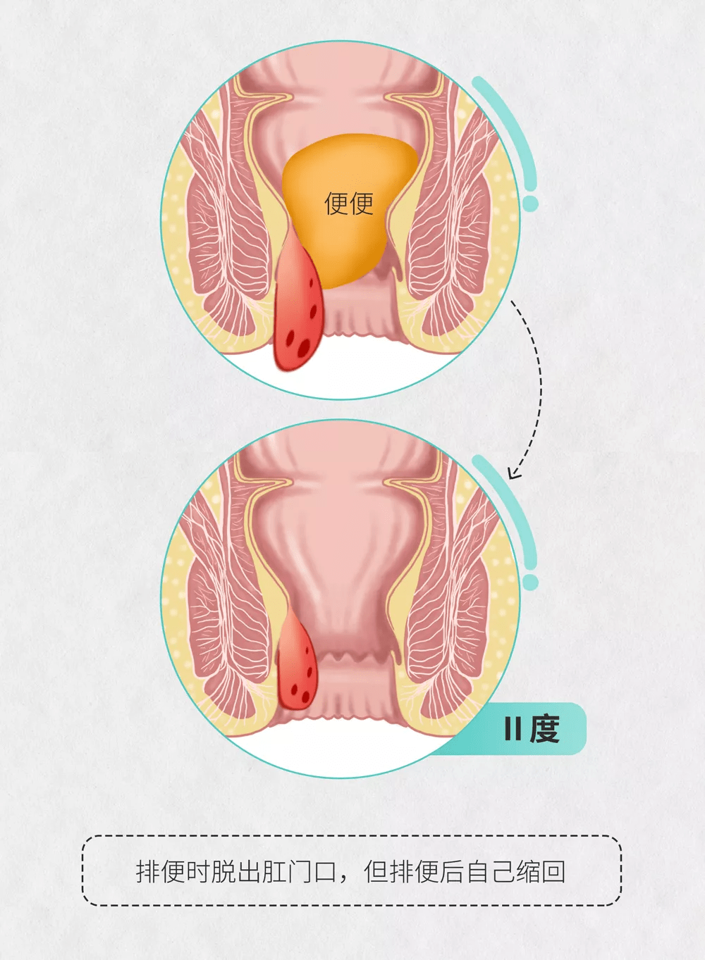 医学图说|十男九痔,你真的了解痔疮吗?