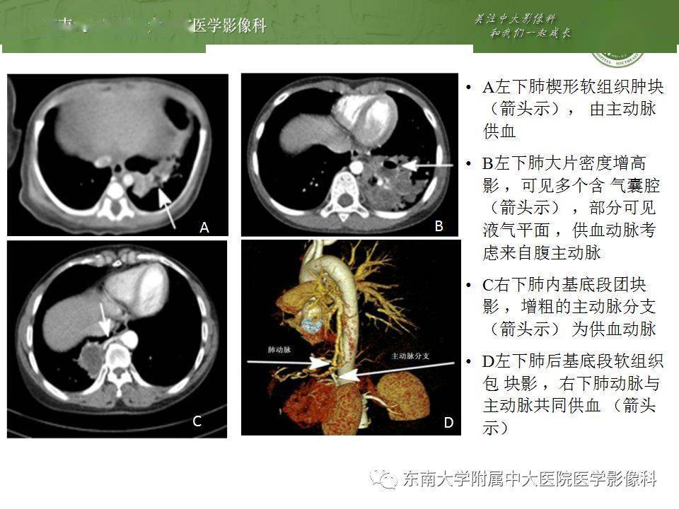 病例结果:肺隔离症编辑/校对:郑孝飞增强ct女,38岁,因"间断咯血2个月"