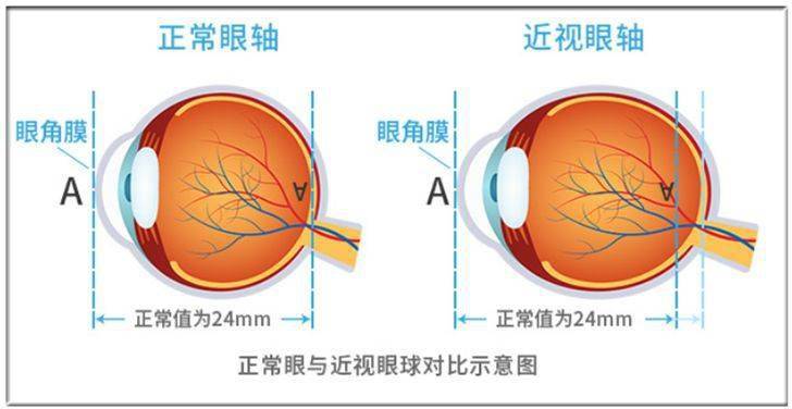 5-24毫米,高度近视患者的眼轴普遍要长一点,据数据显示,  近视每增加