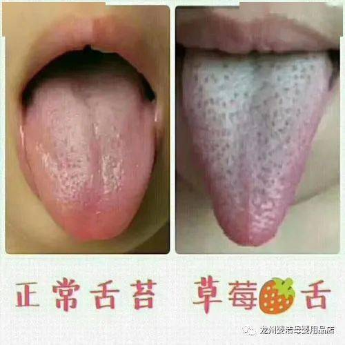 宝宝发烧期间,出现  草莓舌,病情持续  2~3天后,舌变成  杨梅舌—