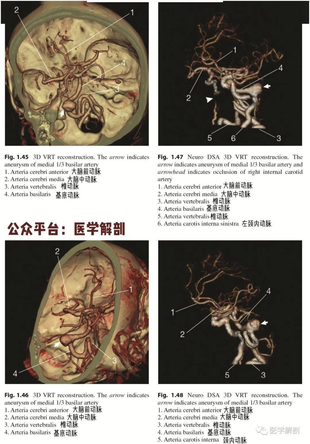 脑cta图谱 | 基底动脉瘤详细解剖及复查