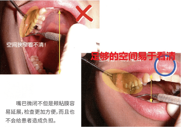 牙周袋深度测定法_探针