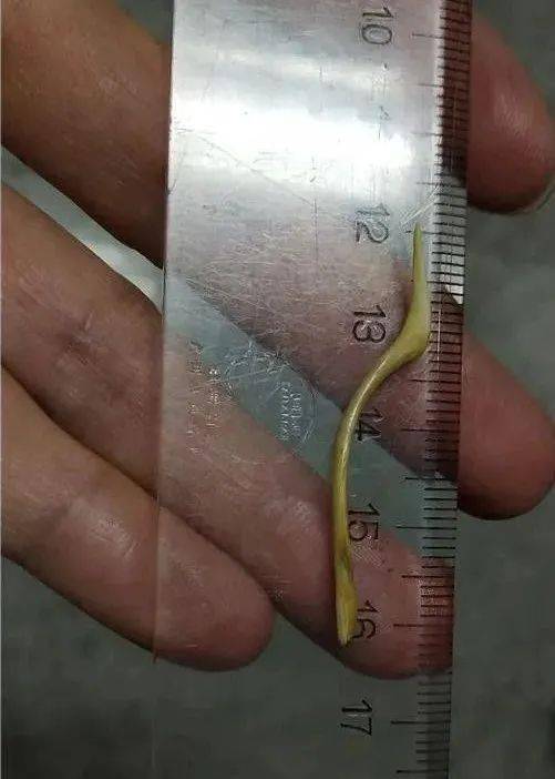一女子喝了靓汤痛到睡不着竟因小肠被刺穿