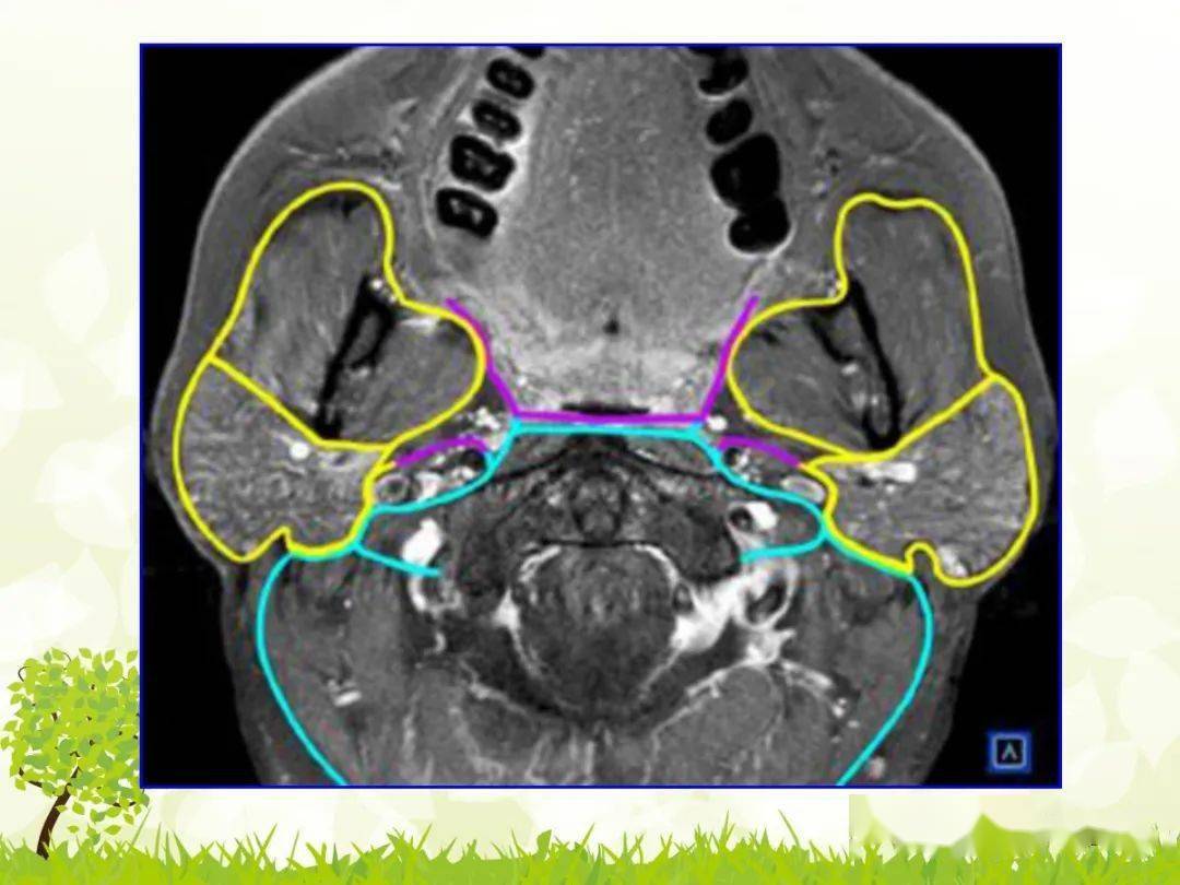 咽旁间隙解剖及常见病变影像表现