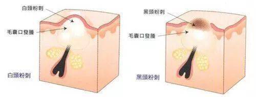 毛孔堵塞是皮肤大忌,更是一种病!