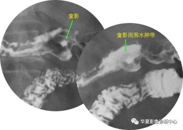 直接征象为 龛影,加压后表现为类 圆形或米粒状钡斑,边缘大多光滑整齐