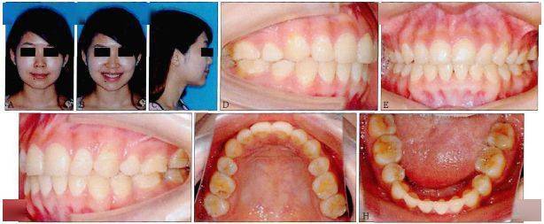【病例分享】薄型牙槽骨的重度前牙开牙合病例治疗一例
