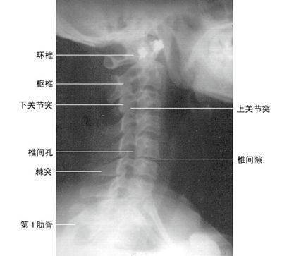 最全总结:脊柱的x线解剖,太赞了