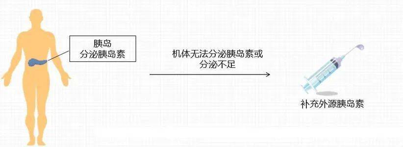 对于1型糖尿病患者来说,由于其胰岛细胞功能衰竭,自身分泌的胰岛素量