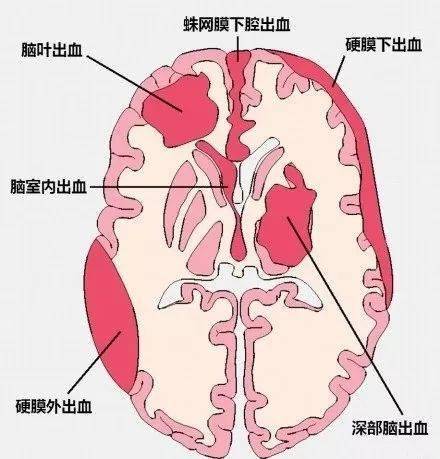 几种类型脑出血的ct表现
