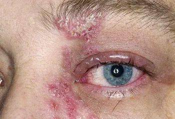 眼部带状疱疹是一种较严重的眼部病,由水痘一带状疱疹病毒感染引起.