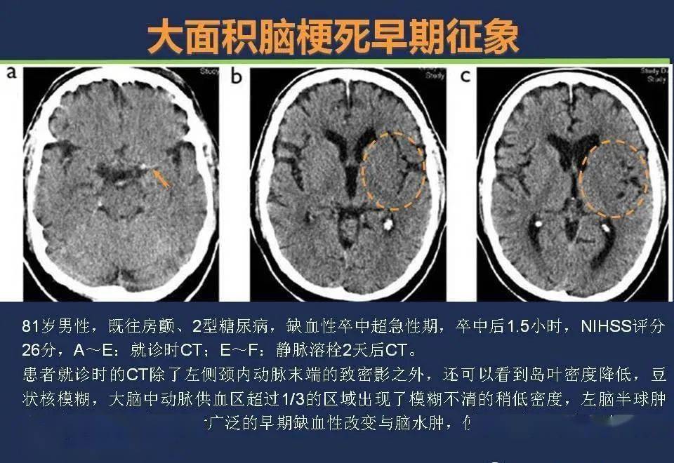 没有mri,超早期如何利用ct诊断脑梗死