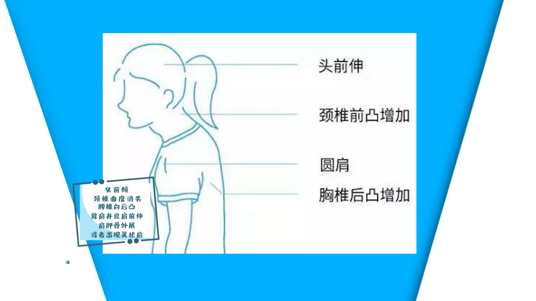 的情况下都不希望宝宝有这样的形象相信每个家长圆肩 弓背 颈后长个富