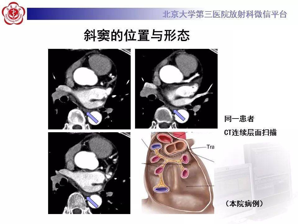心包窦及心包隐窝解剖