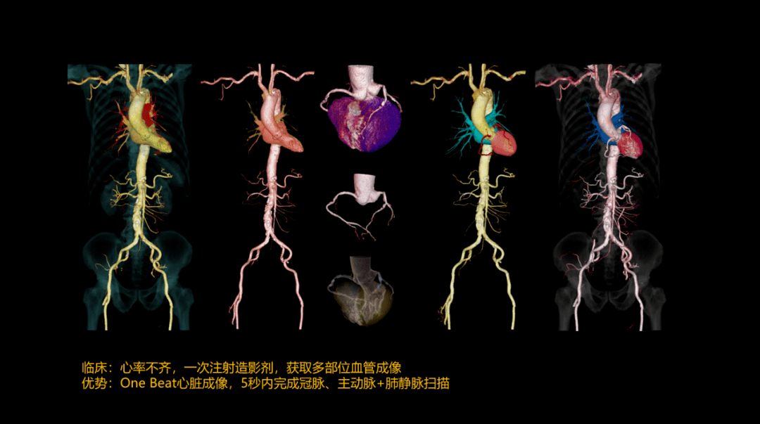 造影剂获取全身多部位血管成像,在5秒内可完成冠脉,主动脉,肺静脉扫描