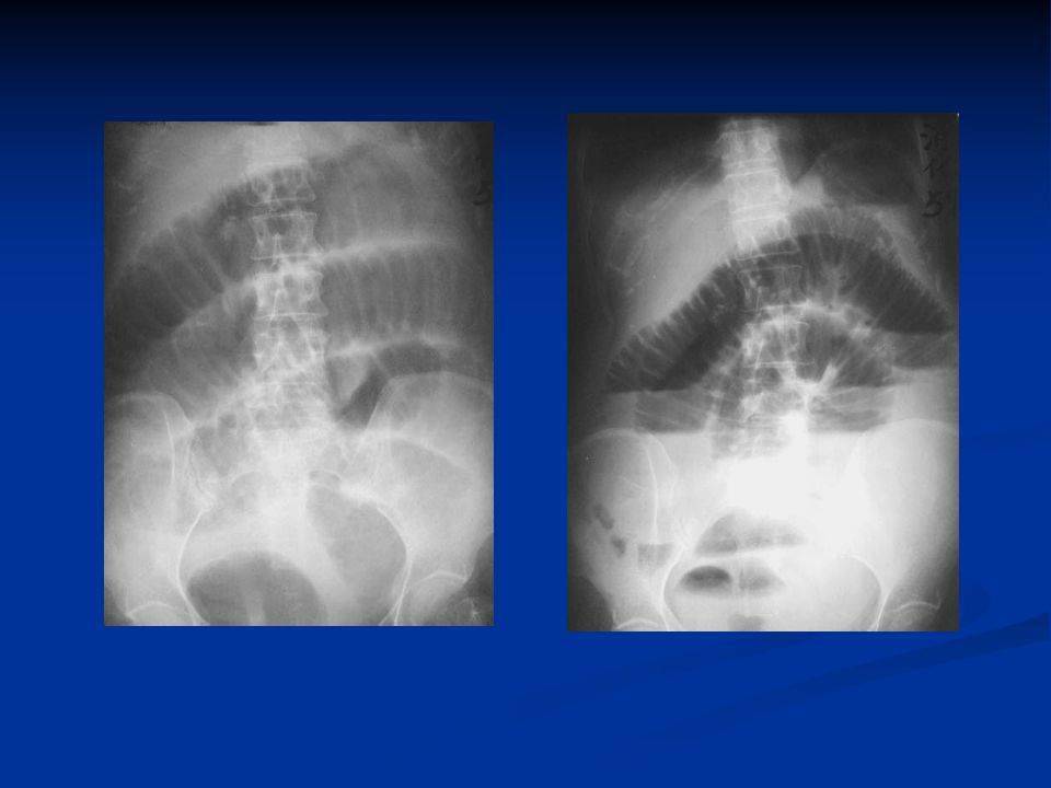 详细肠梗阻的分类及影像学表现高清图片文字讲解