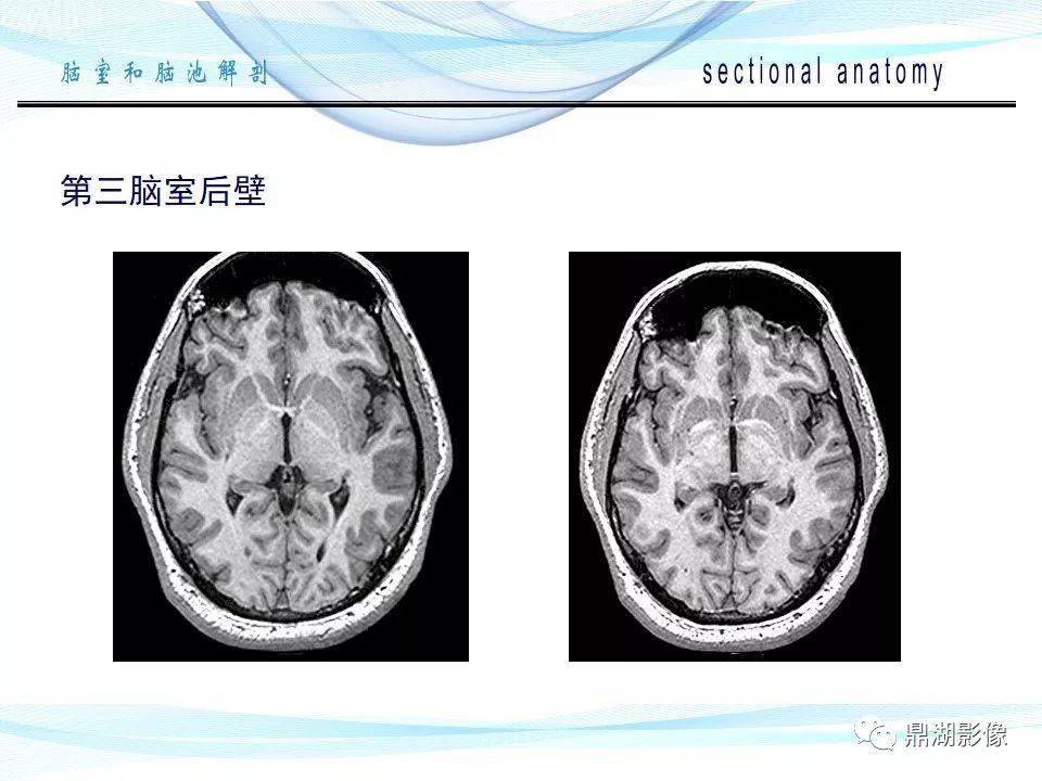 超全详解:脑池和脑室断层解剖