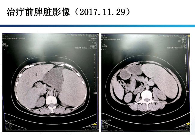 乏力盗汗需警惕逆转脾大终获益