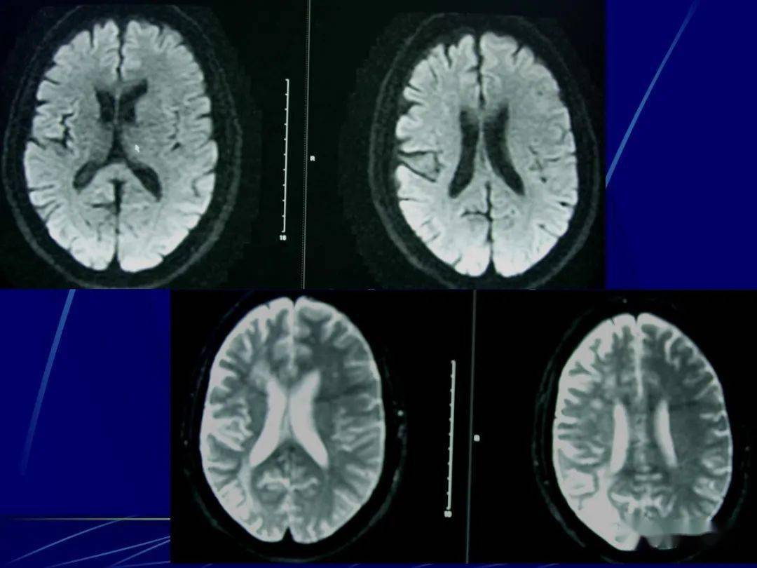 头颅mri中不同序列dwi和adc的区别