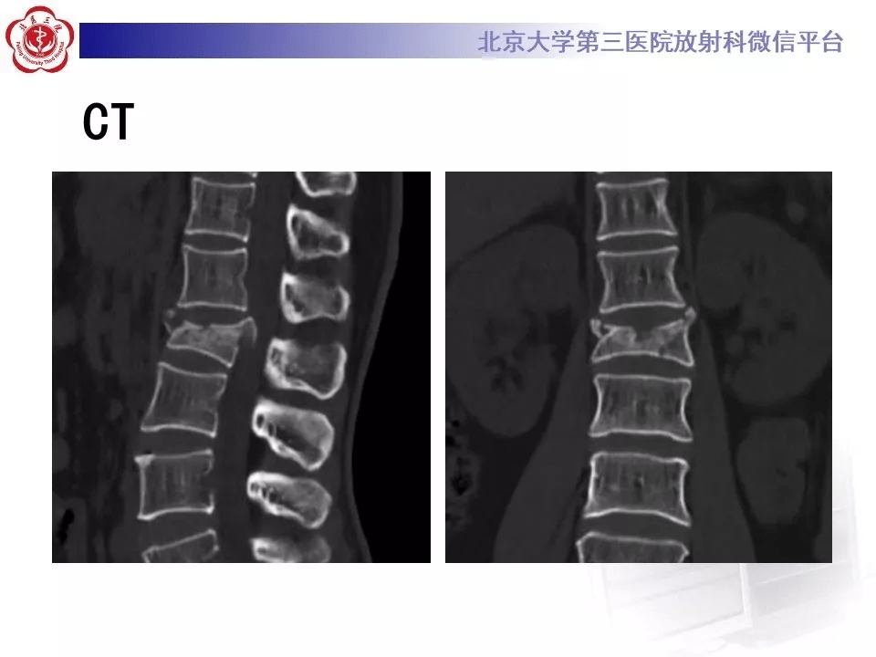 椎体爆裂性骨折影像表现