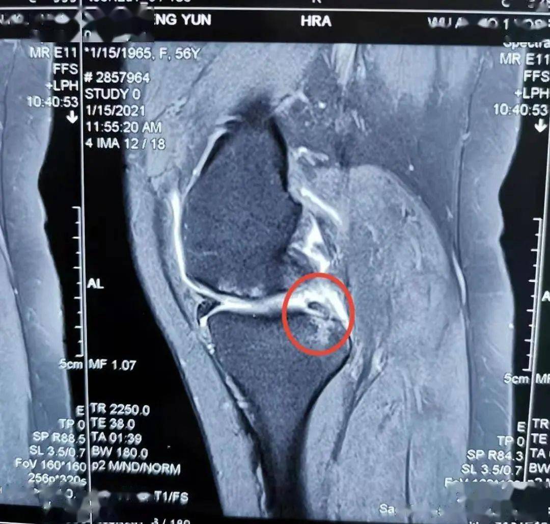 武安一院成功完成一例罕见的内侧半月板损伤修复术