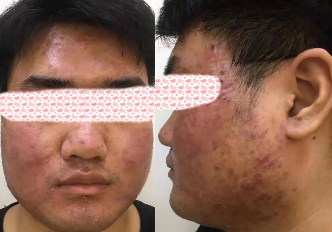 痤疮治疗方法,如光动力治疗技术,果酸焕肤术,粉刺去除术,红蓝黄光疗