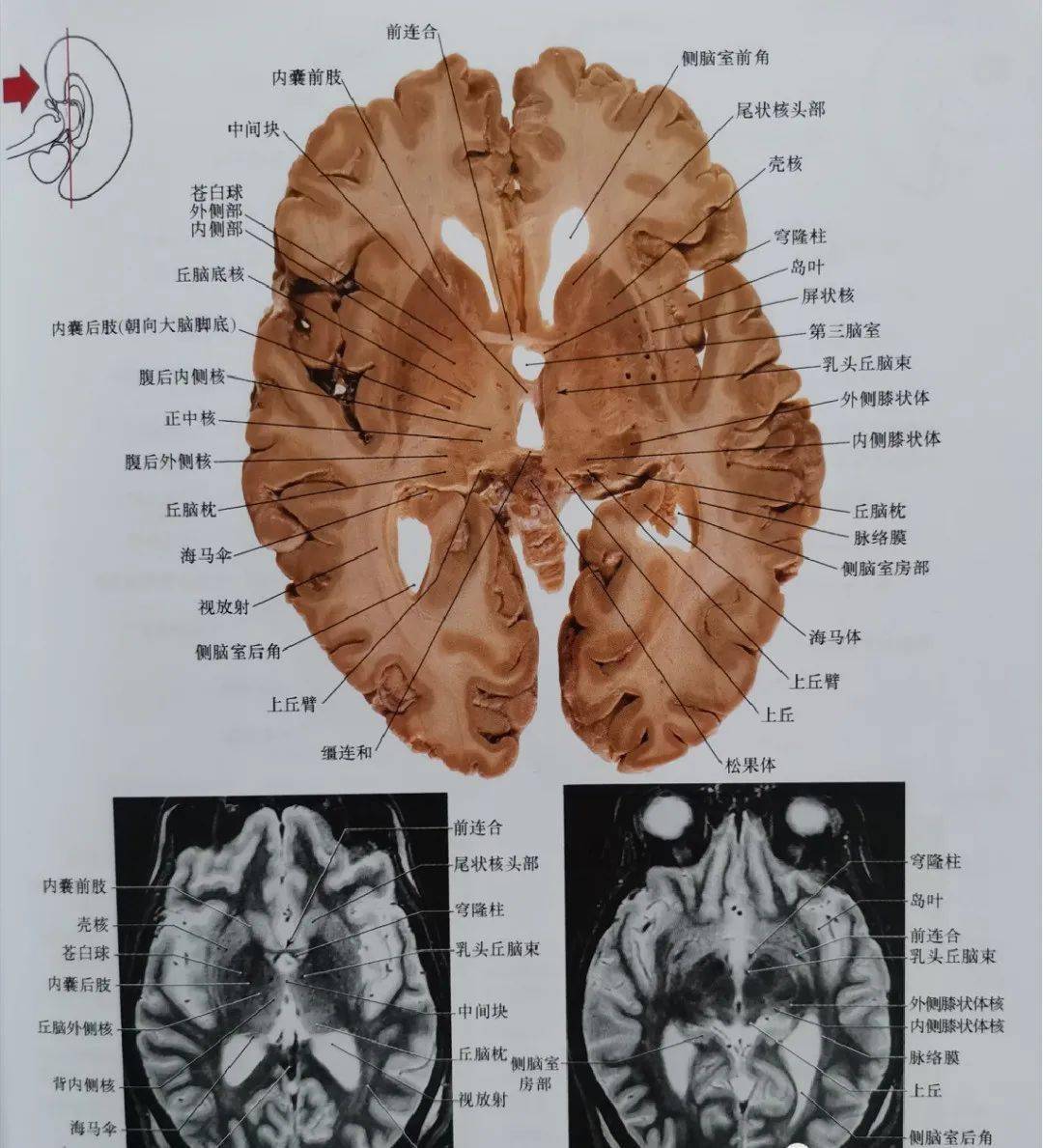 注意丘脑上核的位置,其毗邻内囊后肢,压缩形成大脑脚.