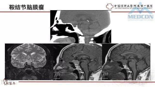 【推荐】鞍区肿瘤性病变的影像诊断思路