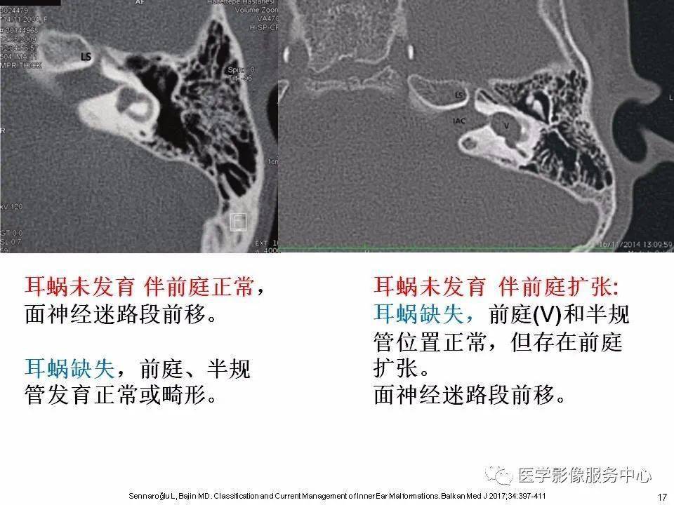 内耳正常解剖及畸形分类