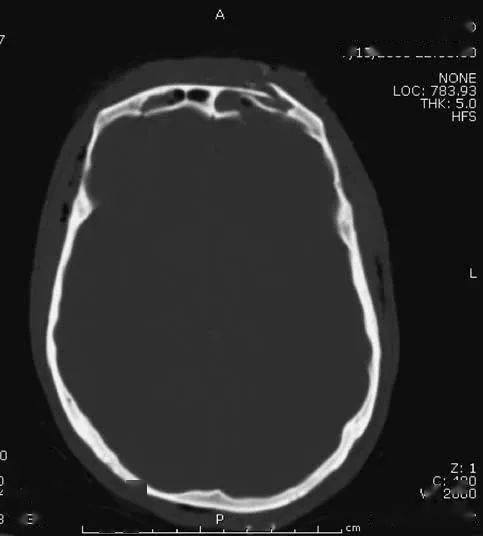 简明又详细的头部ct读片详解!