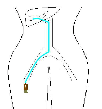 经股动脉穿刺置管灌注化疗的护理