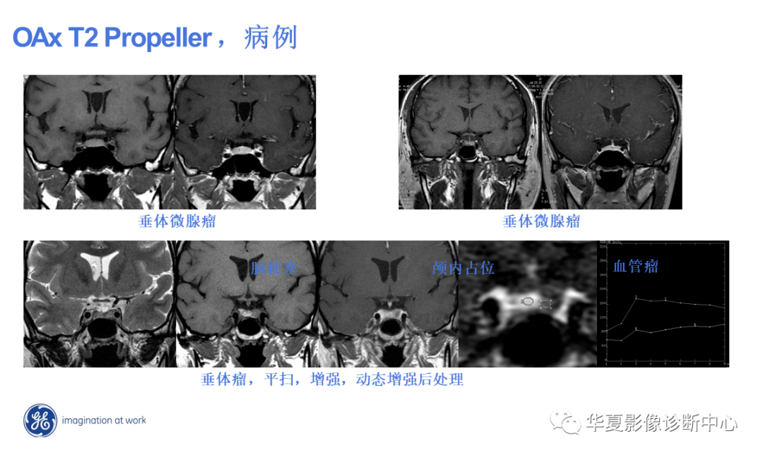 工作必备丨磁共振规范化扫描方案(3.0t)——垂体