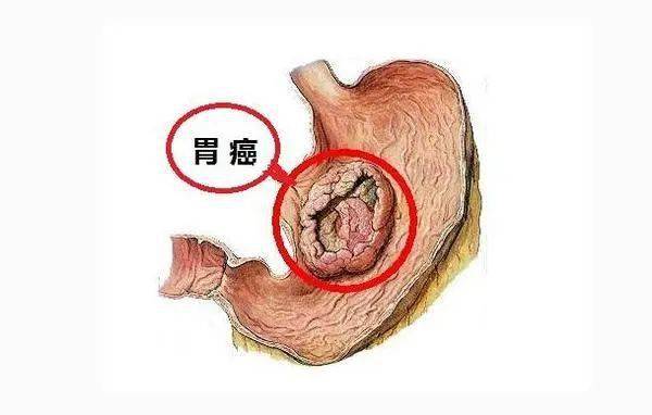 发现胃息肉,这是病变的信号吗?_症状
