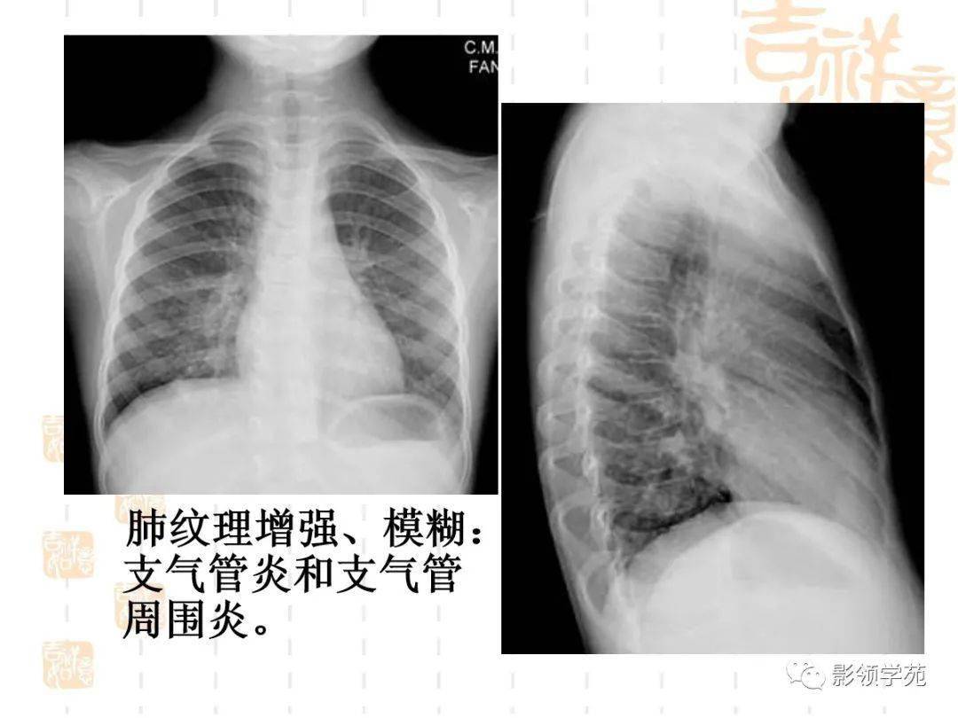 肺部常见疾病的影像诊断_支气管