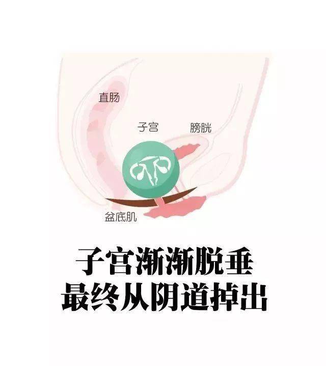 虚弱的盆底肌给了盆腔器官下垂的机会,比如子宫脱垂,阴道壁膨出